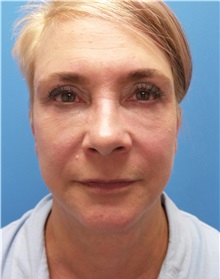 Facelift After Photo by Michael Epstein, MD, FACS; Northbrook, IL - Case 33133