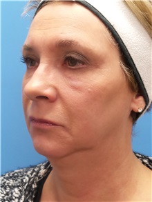 Facelift Before Photo by Michael Epstein, MD, FACS; Northbrook, IL - Case 33133