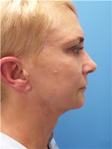 Facelift After Photo by Michael Epstein, MD, FACS; Northbrook, IL - Case 33133