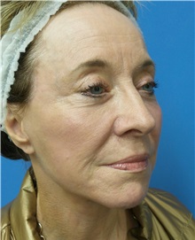 Facelift After Photo by Michael Epstein, MD, FACS; Northbrook, IL - Case 33398