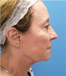 Facelift Before Photo by Michael Epstein, MD, FACS; Northbrook, IL - Case 33398