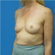 Breast Augmentation Before Photo by Michael Epstein, MD, FACS; Northbrook, IL - Case 33852