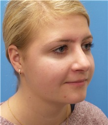 Rhinoplasty After Photo by Michael Epstein, MD, FACS; Northbrook, IL - Case 33944