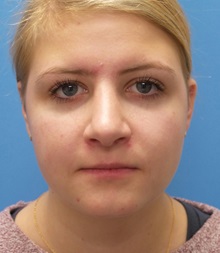 Rhinoplasty After Photo by Michael Epstein, MD, FACS; Northbrook, IL - Case 33944