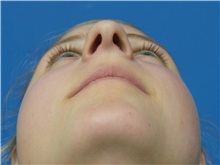 Rhinoplasty Before Photo by Michael Epstein, MD, FACS; Northbrook, IL - Case 33944