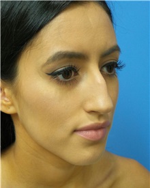 Rhinoplasty Before Photo by Michael Epstein, MD, FACS; Northbrook, IL - Case 34098