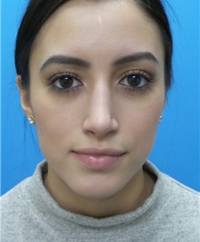Rhinoplasty After Photo by Michael Epstein, MD, FACS; Northbrook, IL - Case 34098