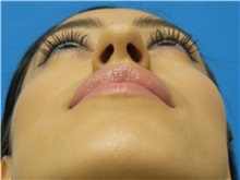 Rhinoplasty Before Photo by Michael Epstein, MD, FACS; Northbrook, IL - Case 34098