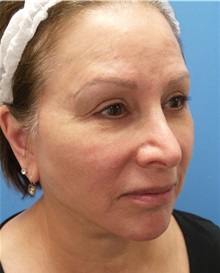 Facelift After Photo by Michael Epstein, MD, FACS; Northbrook, IL - Case 34608
