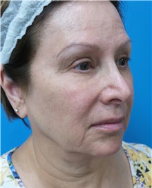 Facelift Before Photo by Michael Epstein, MD, FACS; Northbrook, IL - Case 34608