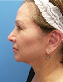 Facelift After Photo by Michael Epstein, MD, FACS; Northbrook, IL - Case 34608