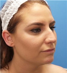 Rhinoplasty Before Photo by Michael Epstein, MD, FACS; Northbrook, IL - Case 35347