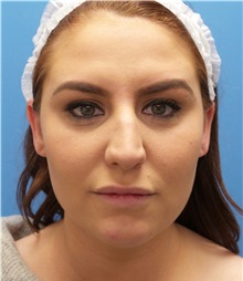 Rhinoplasty Before Photo by Michael Epstein, MD, FACS; Northbrook, IL - Case 35347