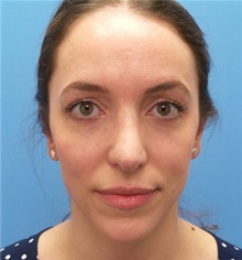 Rhinoplasty After Photo by Michael Epstein, MD, FACS; Northbrook, IL - Case 35683
