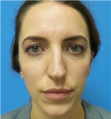 Rhinoplasty Before Photo by Michael Epstein, MD, FACS; Northbrook, IL - Case 35683
