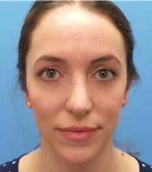 Brow Lift After Photo by Michael Epstein, MD, FACS; Northbrook, IL - Case 35684