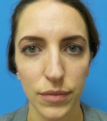 Brow Lift Before Photo by Michael Epstein, MD, FACS; Northbrook, IL - Case 35684