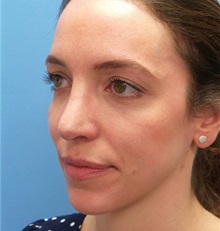 Brow Lift After Photo by Michael Epstein, MD, FACS; Northbrook, IL - Case 35684