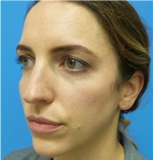 Brow Lift Before Photo by Michael Epstein, MD, FACS; Northbrook, IL - Case 35684