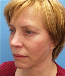 Facelift After Photo by Michael Epstein, MD, FACS; Northbrook, IL - Case 35744