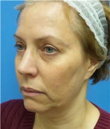 Facelift Before Photo by Michael Epstein, MD, FACS; Northbrook, IL - Case 35744