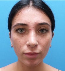 Rhinoplasty After Photo by Michael Epstein, MD, FACS; Northbrook, IL - Case 36351