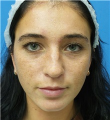 Rhinoplasty Before Photo by Michael Epstein, MD, FACS; Northbrook, IL - Case 36351
