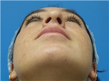 Rhinoplasty Before Photo by Michael Epstein, MD, FACS; Northbrook, IL - Case 36351