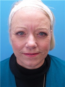 Facelift After Photo by Michael Epstein, MD, FACS; Northbrook, IL - Case 38386