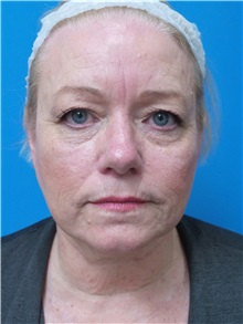 Facelift Before Photo by Michael Epstein, MD, FACS; Northbrook, IL - Case 38386