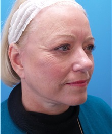 Facelift After Photo by Michael Epstein, MD, FACS; Northbrook, IL - Case 38386