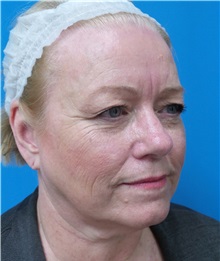 Facelift Before Photo by Michael Epstein, MD, FACS; Northbrook, IL - Case 38386