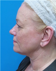Facelift Before Photo by Michael Epstein, MD, FACS; Northbrook, IL - Case 38386