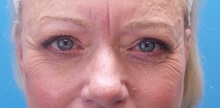 Eyelid Surgery After Photo by Michael Epstein, MD, FACS; Northbrook, IL - Case 38388