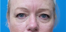Eyelid Surgery Before Photo by Michael Epstein, MD, FACS; Northbrook, IL - Case 38388