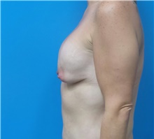 Breast Augmentation Before Photo by Michael Epstein, MD, FACS; Northbrook, IL - Case 39752
