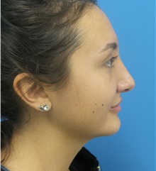Rhinoplasty After Photo by Michael Epstein, MD, FACS; Northbrook, IL - Case 40625