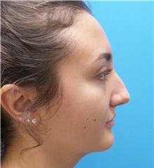 Rhinoplasty Before Photo by Michael Epstein, MD, FACS; Northbrook, IL - Case 40625