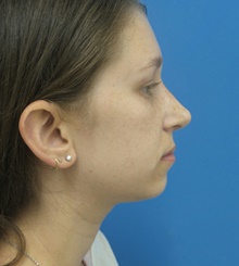 Rhinoplasty After Photo by Michael Epstein, MD, FACS; Northbrook, IL - Case 40945