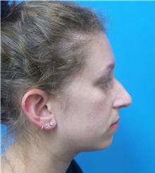 Rhinoplasty Before Photo by Michael Epstein, MD, FACS; Northbrook, IL - Case 40945