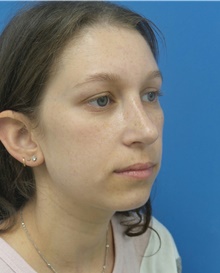 Rhinoplasty After Photo by Michael Epstein, MD, FACS; Northbrook, IL - Case 40945