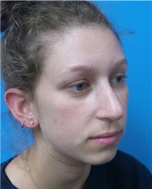 Rhinoplasty Before Photo by Michael Epstein, MD, FACS; Northbrook, IL - Case 40945