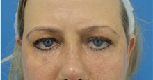 Eyelid Surgery After Photo by Michael Epstein, MD, FACS; Northbrook, IL - Case 40975