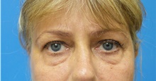 Eyelid Surgery Before Photo by Michael Epstein, MD, FACS; Northbrook, IL - Case 40975