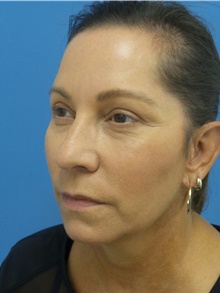 Facelift After Photo by Michael Epstein, MD, FACS; Northbrook, IL - Case 41401