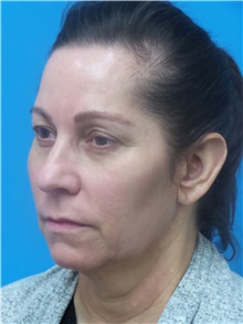 Facelift Before Photo by Michael Epstein, MD, FACS; Northbrook, IL - Case 41401