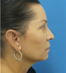 Facelift After Photo by Michael Epstein, MD, FACS; Northbrook, IL - Case 41401