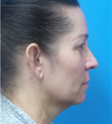 Facelift Before Photo by Michael Epstein, MD, FACS; Northbrook, IL - Case 41401