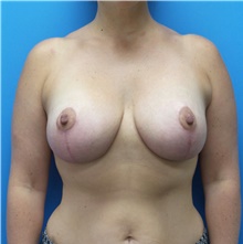 Breast Lift After Photo by Michael Epstein, MD, FACS; Northbrook, IL - Case 41692