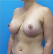 Breast Lift After Photo by Michael Epstein, MD, FACS; Northbrook, IL - Case 41692